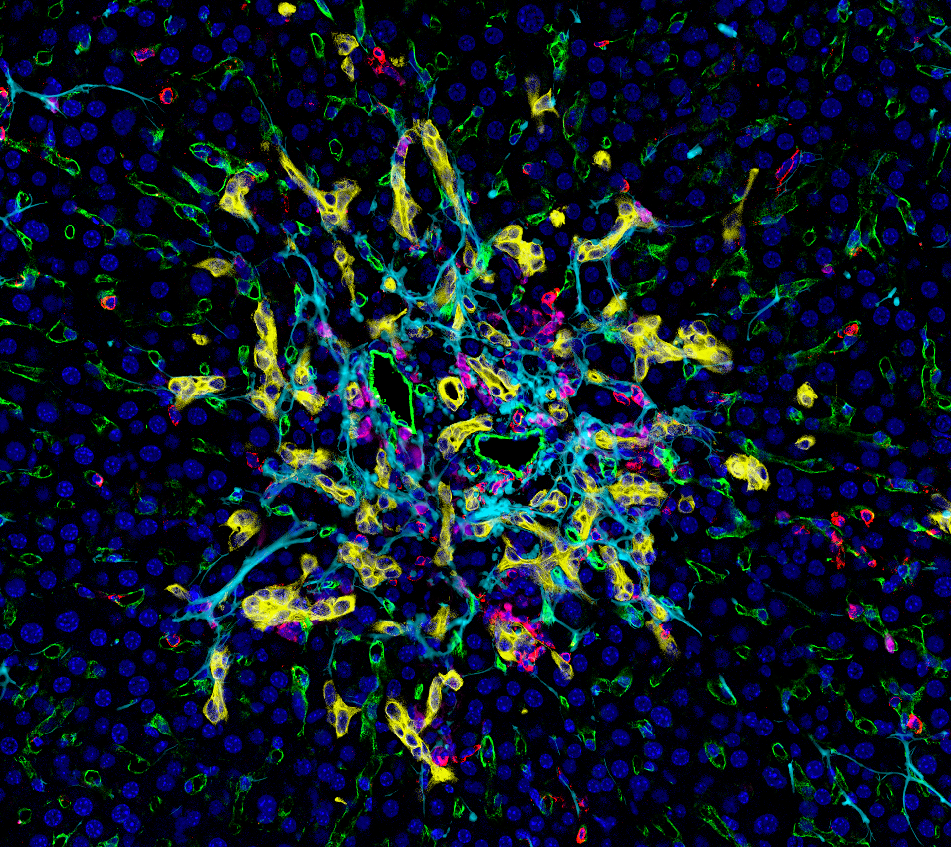 A colorful multiplex immunofluorescence microscopic image of a biliary atresia mouse model liver cross-section. The image shows a portal area crowded with cyan-colored scar tissue, yellow-stained bile ducts, and magenta/red immune cell infiltration against a dark background with blue cell nuclei.